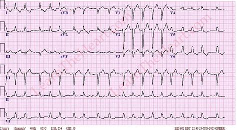 Bundle Branch Block