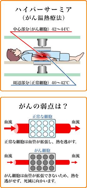 癌 温熱療法 効果 Hello Doctor