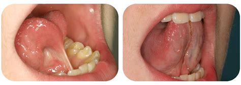 Lingual Frenectomy Before And After