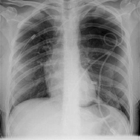 Plain Film Bilateral Pneumothorax With Drainage Discrete Metastatic