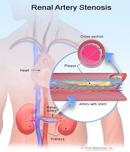 Renal Artery Stenosis Treatment Symptoms Diagnosis Causes