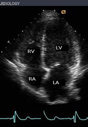 Echo Transthoracic Echo Standard Views Flashcards Quizlet