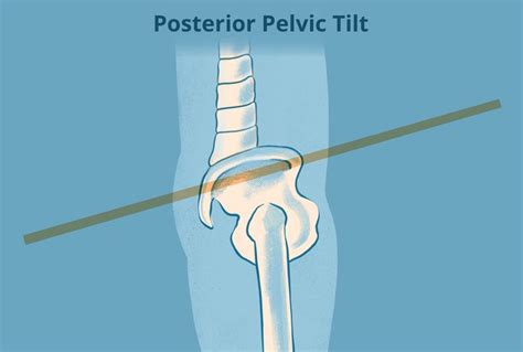 Posterior Pelvic Tilt Causes Symptoms And Treatment