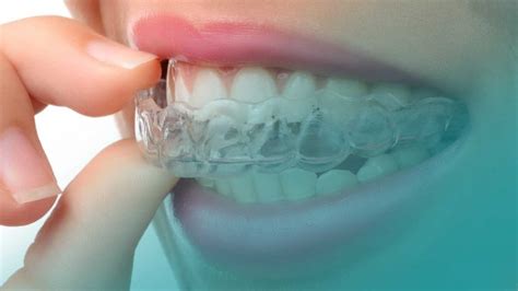 Updating The Ca Clear Aligner Therapy