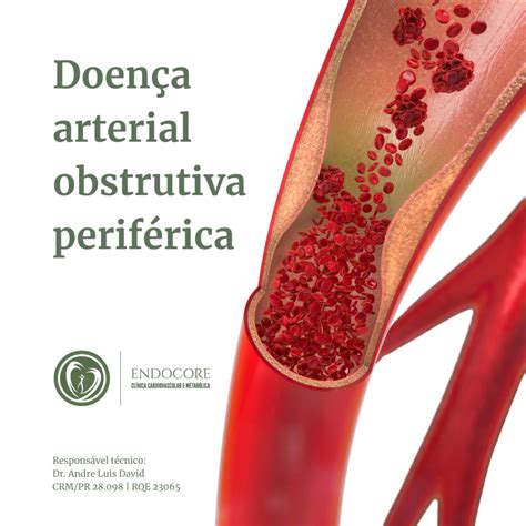 Doença Arterial Obstrutiva Periférica Endocore