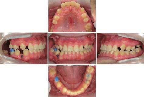 Post Orthodontic Treatment Intraoral View A Occlusal View Of