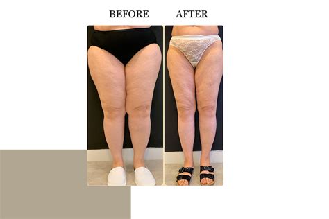 Lipedema | Before & After