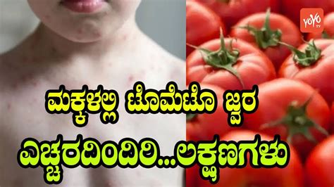 Tomato Fever Symptoms Precautions Cause Treatment Tomato Fever In