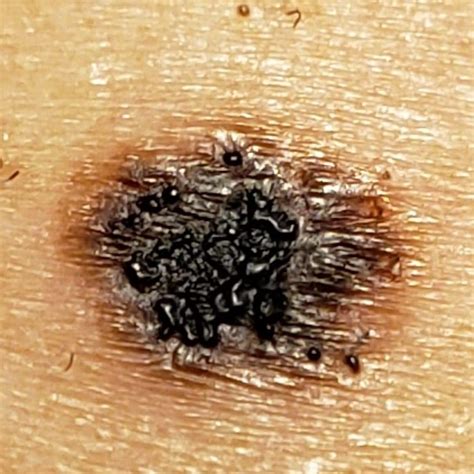 List 98 Pictures Anatomy Of A Mole On The Skin Updated