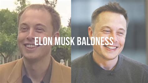 Did Elon Musk have a hair transplant? - BALD LIFESTYLE