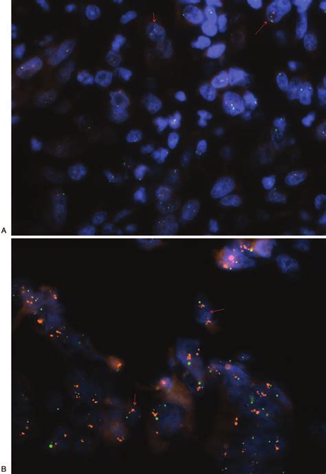 A Dual Color Fluorescent In Situ Hybridization Assay Demonstrating Her