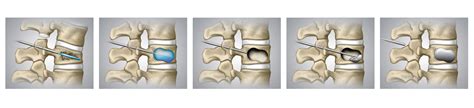 Kyphoplasty Vertebroplasty Mmra