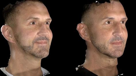 Male Dermal Fillers Before After Results At Quinn Clinics Bristol