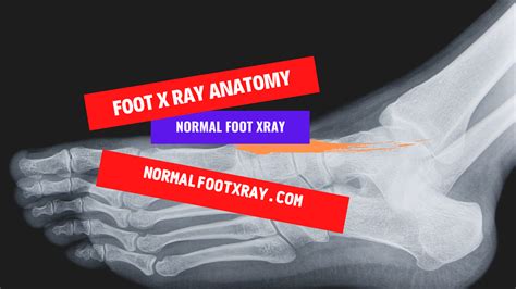 Foot X-Ray Anatomy – Normal Foot X Ray in 2022 | X ray, Anatomy, Diastasis