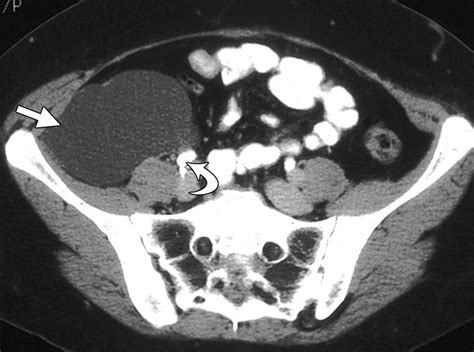 Imaging Of Uncommon Retroperitoneal Masses Radiographics