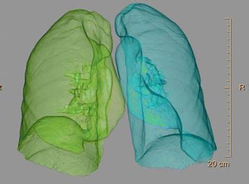 Emphysema quantification by CT - European Radiology Experimental