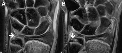 50+ Tfcc Wrist Mri PNG | Mri, Mri scan, Wrist injury