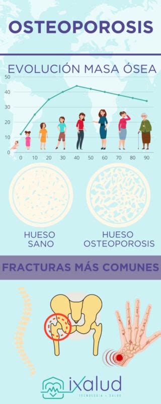 Osteoporosis Síntomas Y Tratamiento Ixalud Es