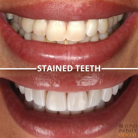 How Do Veneers Work All You Need To Know Before Getting The Treatment