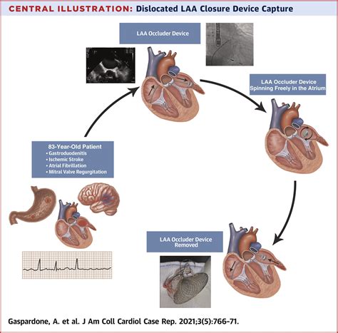 Percutaneous Retrieval Of A Left Atrial Appendage Closure Device The