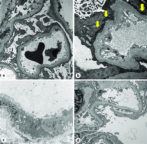 Ultrastructural Changes In Mcd A Extensive Near Complete Effacement Of