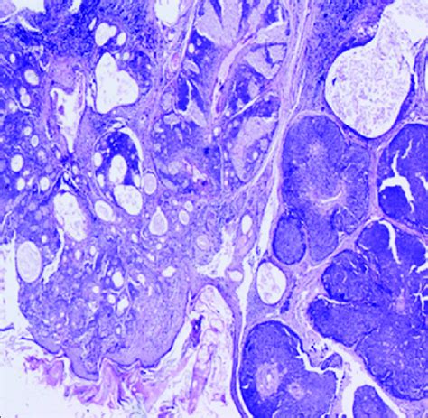 Nests And Lobules Of Basaloid Cells With Few Mature Sebocytes Arising