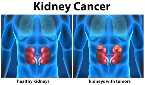 Premium Vector Diagram Showing Kidney Cancer In Human