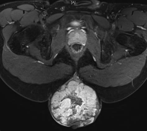 Axial MRI images of sacral region demonstrating an exophytic mass with ...