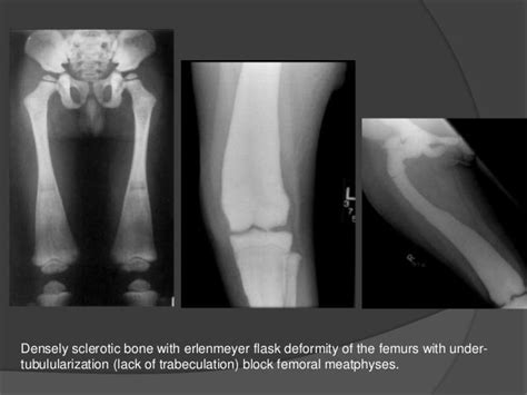 Osteopetrosis