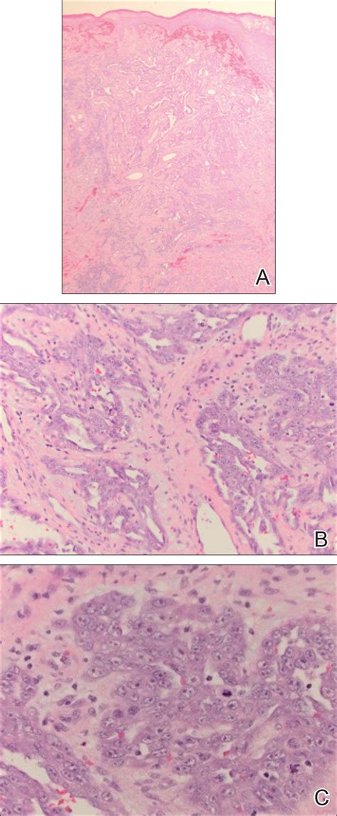 Cutaneous Angiosarcoma Of The Lower Leg Mdedge Dermatology