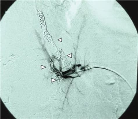 A Portal Venogram Showing The Right Portal Vein White Arrow The