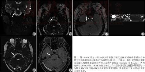 磁共振神经成像对典型三叉神经痛压迫位置与疼痛区域相关性的研究 知乎