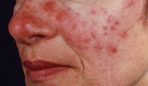 Red in the face: We look at rosacea and treatments that work | BLUE HARE MAGAZINE