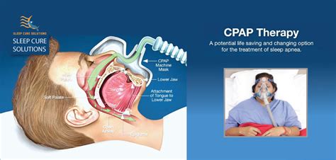 Cpap Diagram