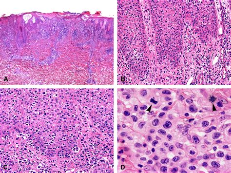 A Patient With Clinicopathologic Features Of Small Plaque Parapsoriasis