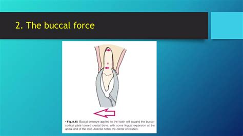 Mechanical Principles Involved In Tooth Extraction 1 Ppt