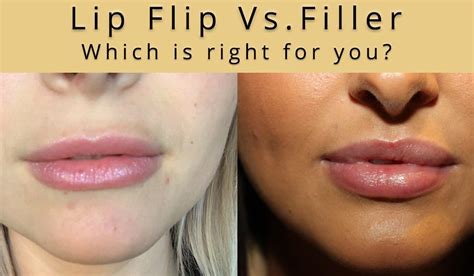 Can You Do Botox In Your Lips Lipstutorial Org