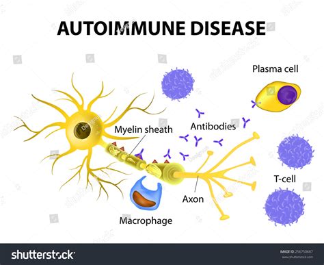 Autoimmune Disease Multiple Sclerosis Immune Cells Attack The Myelin Sheath That Surrounds