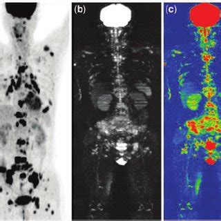 Pet Ct A Wb Dwi B And Whole Body Adc C Successfully