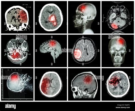 Collection Of Brain Disease Ct Scan And Mri Of Brain Show Cerebral