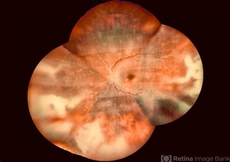 Acute Retinal Necrosis Arn Ophthalmology Education