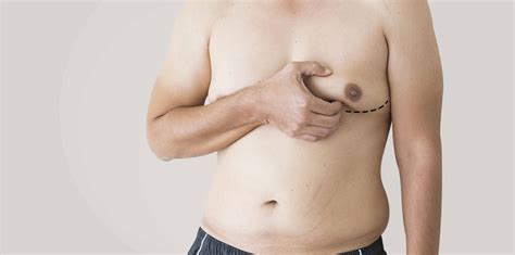 Gynecomastia Surgery In Turkey Discover All Costs