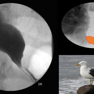 Upper GI fluoroscopy demonstrating transient horizontal ridges ...