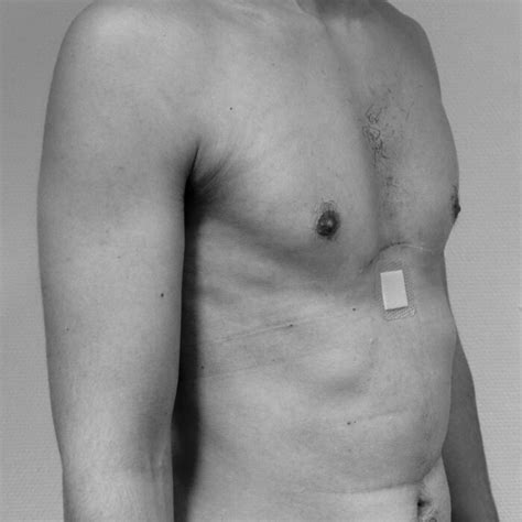 Pectus excavatum Dr Amandine Bonte Chirurgie plastique esthétique