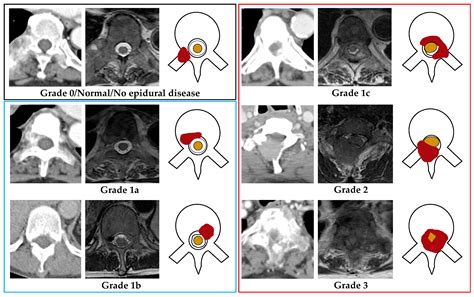 Cancers Free Full Text Diagnostic Accuracy Of Ct For Metastatic