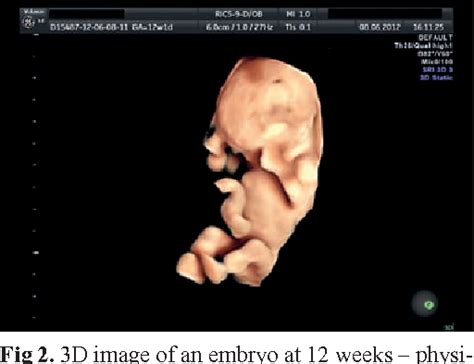 Figure 2 From The Fetal Abdominal Wall Defects Using 2D And 3D