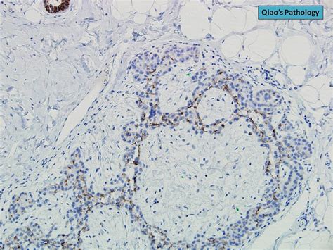 Qiao S Pathology Lobular Neoplasia Alh Lcis With Pagetoid Growth In