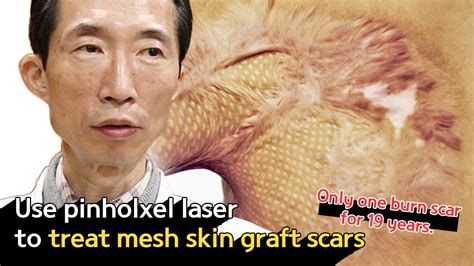 Mesh Skin Graft Scar Three Pinholxel Treatments Have Had This Much