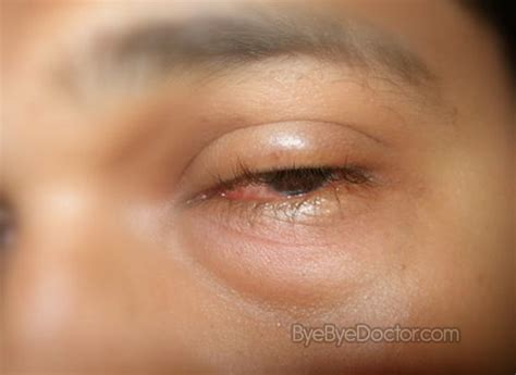 Eyelid Swelling Treatment Symptoms Causes Treatment And Prevention Of Diseases