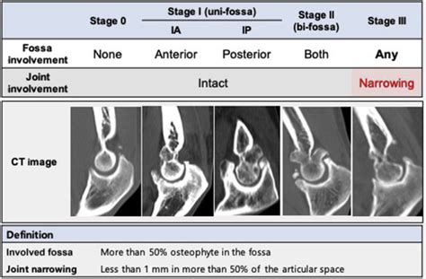 Arthroscopic Osteocapsular Arthroplasty For Advanced Stage Primary